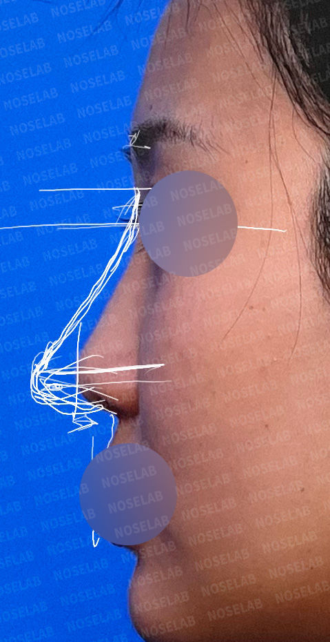 Preoperative right lateral photo showing a short and small nose before Deviated and Small Nose Correction – Closed Rhinoplasty Korea.