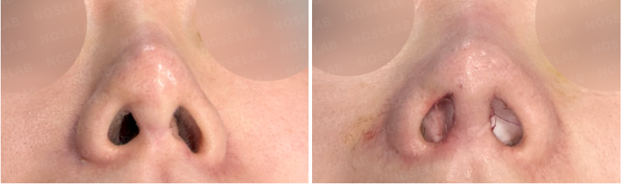 Repeated Dermal Absorption Nose Revision – Before (Left) and Immediately After Surgery (Right) Nostril View