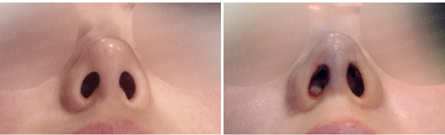 Before and immediately after surgery nostril view showing improved nostril symmetry and refined nasal tip structure following revision closed rhinoplasty with lateral osteotomy and autologous rib cartilage.