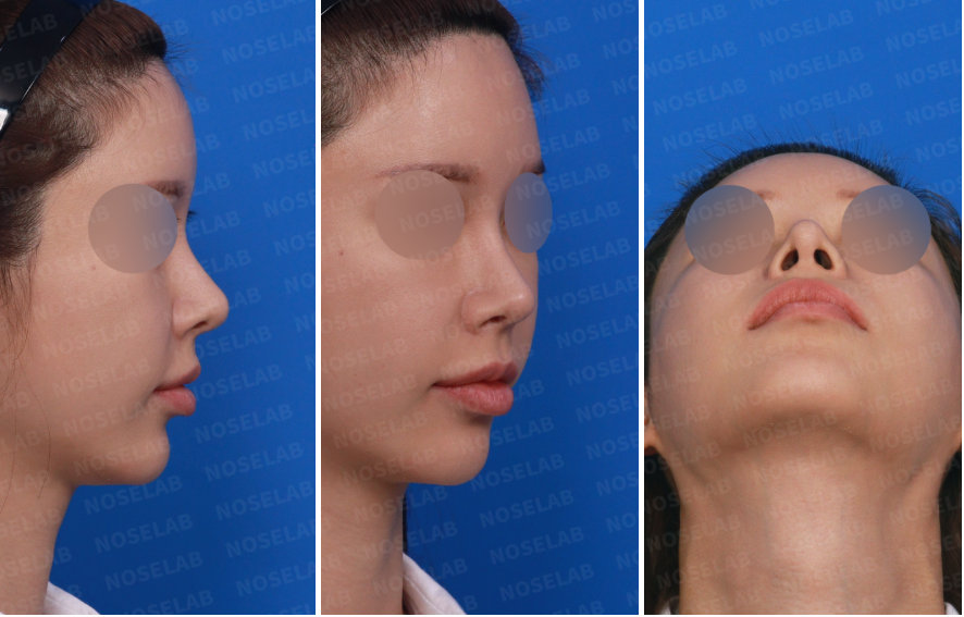 Preoperative consultation photos for short nose correction — right side, right oblique, and nostril views highlighting nasal tip rotation and asymmetry before surgery.