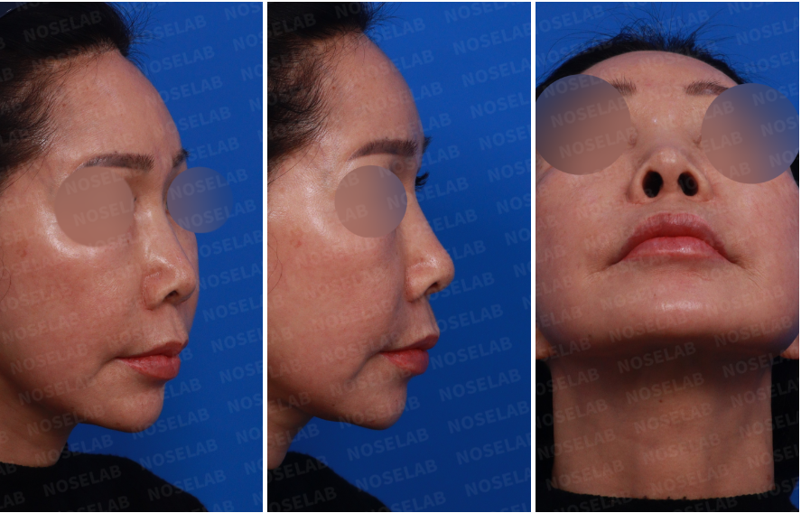 Design consultation photos showing the patient’s right side, oblique side, and nostril view prior to foreign material removal and rib cartilage reconstruction surgery.