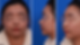 Natural nose height correction consultation photos – frontal, left side, and oblique side views before surgery, showing low nasal bridge and droopy nasal tip.