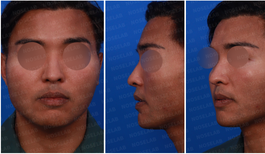 Pre-operative consultation photos for deviated septum and wide nose correction – frontal, left side, and oblique views of the patient's face