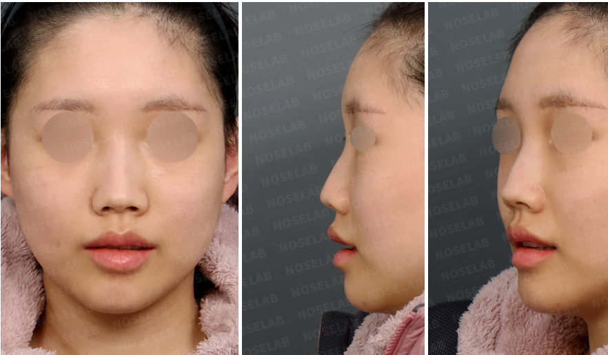 Preoperative design consultation photos showing a crooked nasal bridge and drooping nasal tip from frontal, left oblique, and left lateral views.