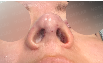 mmediately after droopy nose and hump correction rhinoplasty – nostril view showing improved symmetry and corrected columella position.