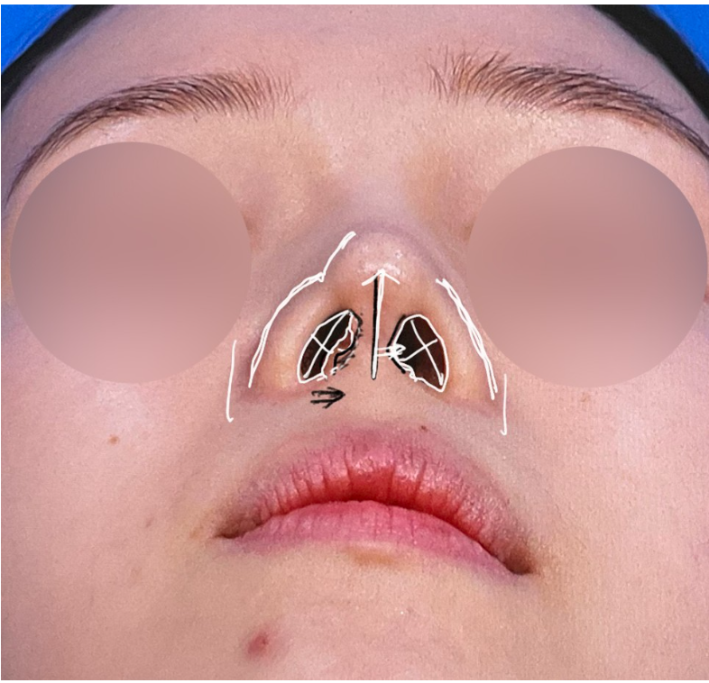 Nostril base view photo showing preoperative consultation design for nostril asymmetry correction, highlighting the tilted columella and uneven nostril shape before surgery.