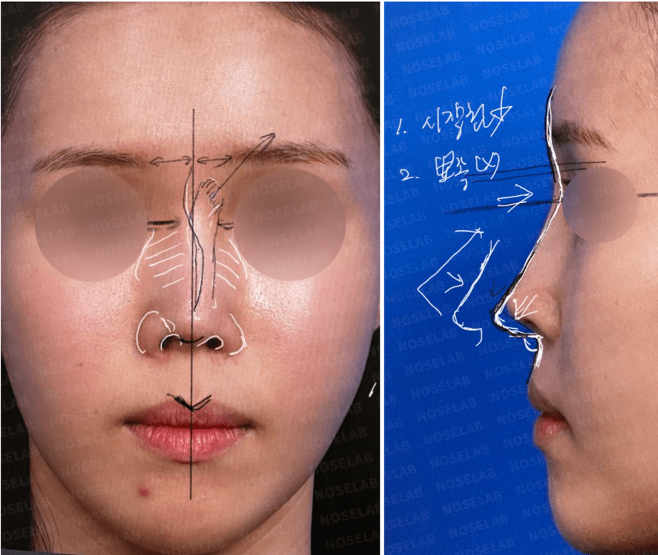 Frontal and side view photos showing preoperative consultation design for nostril asymmetry correction, indicating nasal deviation to the left and planned adjustments for nose bridge and tip alignment.