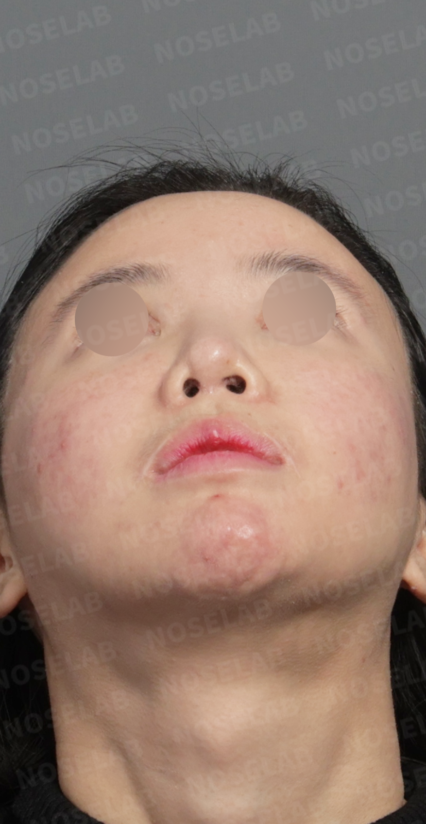 Preoperative consultation: nostril view.