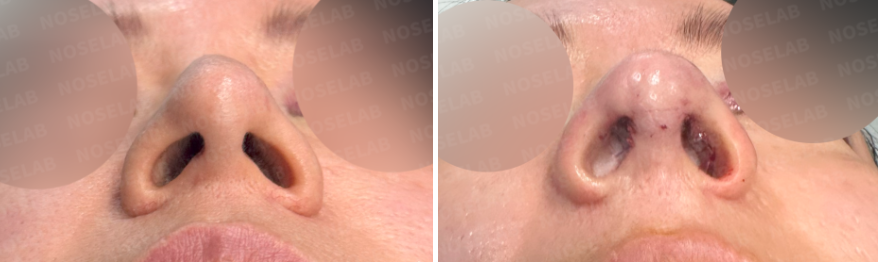 Before and immediately after droopy nose and hump correction rhinoplasty – nostril view showing improved symmetry and corrected columella retraction.
