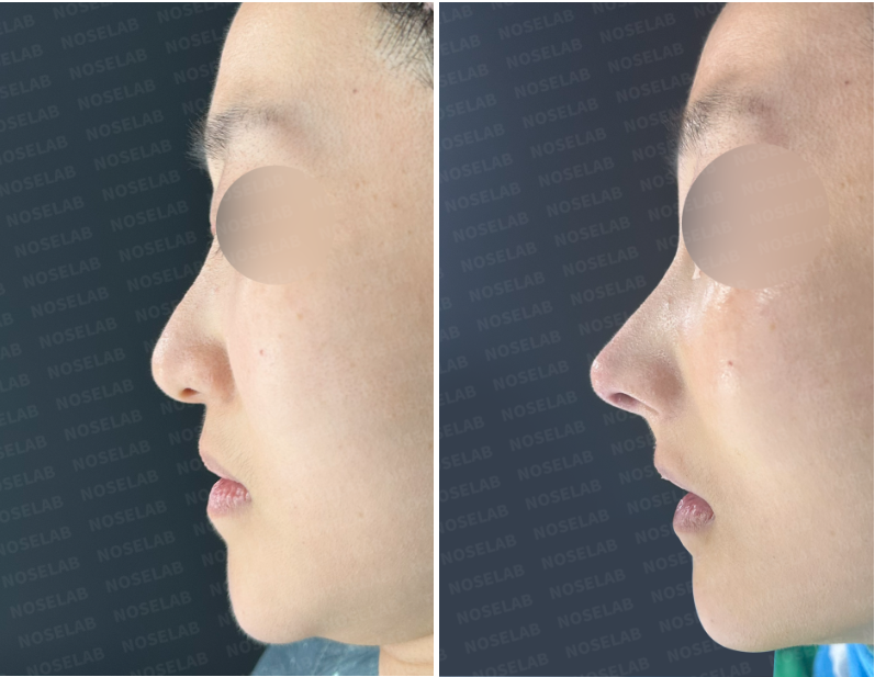 Closed rhinoplasty Korea before and after photos – right side view of a patient with a corrected long nose, nasal deviation, and facial asymmetry.