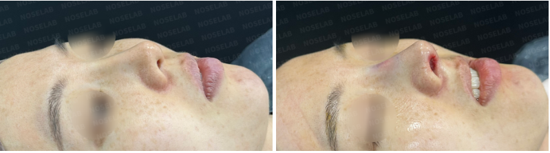 Before and after 45-degree angle photos showing improved nasal tip projection and smoother nasal bridge.