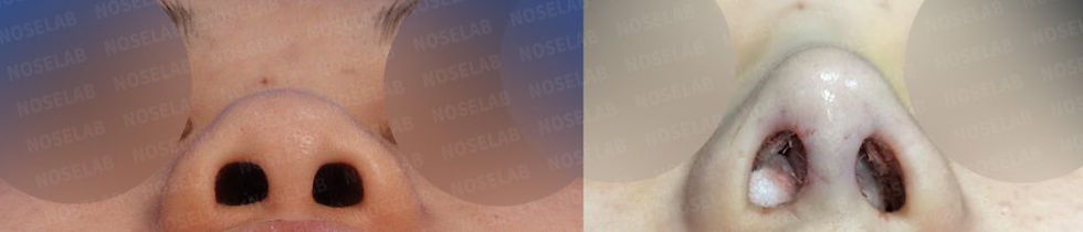 Before and after basal photos showing symmetrical nostrils and corrected deviation after Deviated and Small Nose Correction – Closed Rhinoplasty Korea.
