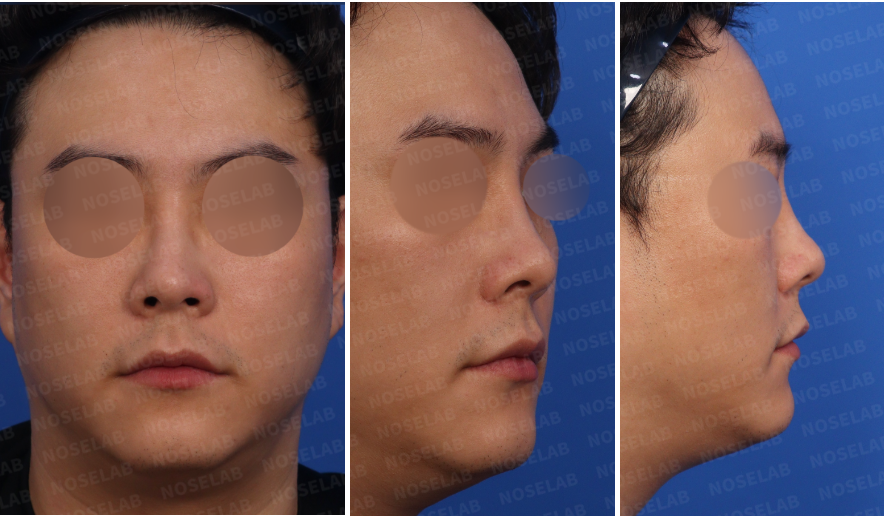 Preoperative consultation photos for male rhinoplasty Korea: frontal view, left oblique side view, and left side view
