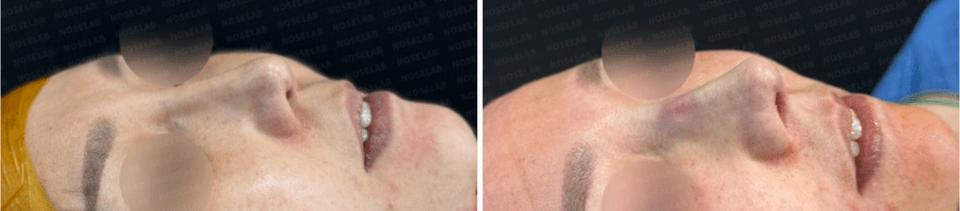 Before and After Surgery Photos. Before surgery (left), after surgery (right)