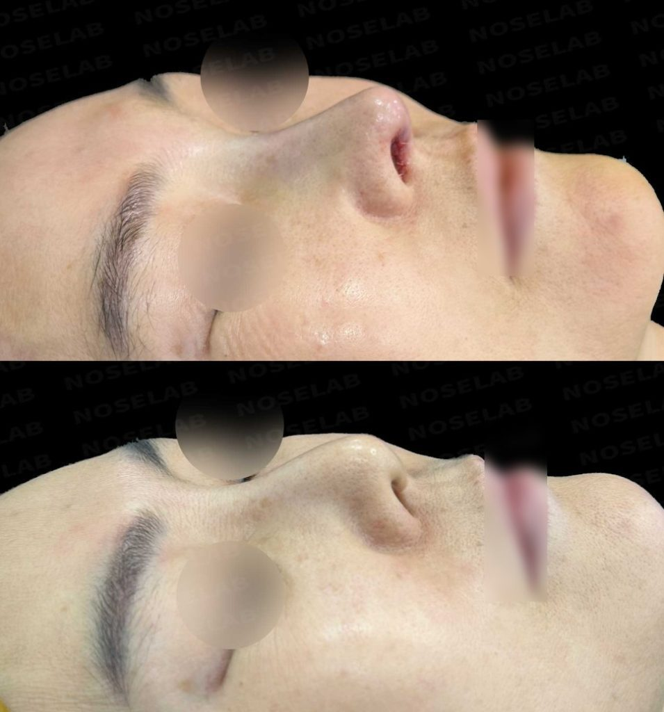 Oblique view before and after Contracted Nose Correction using autologous rib cartilage