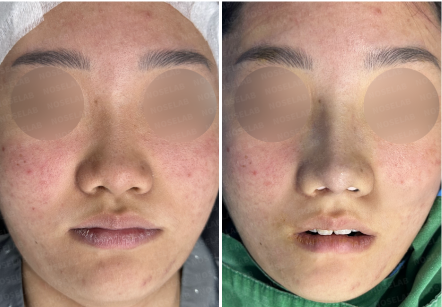 Before and immediately after closed rhinoplasty frontal view showing increased nasal bridge height, refined bulbous nasal tip, and improved columella position using autologous rib cartilage.