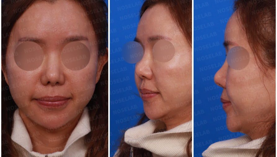Design consultation photos showing the patient’s frontal, left profile, and oblique side views before secondary rhinoplasty after silicone removal.