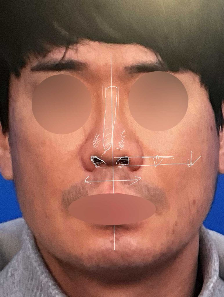 Preoperative design consultation, frontal view for Upturned Nose and Asymmetric Nostrils Correction – Closed Rhinoplasty Korea
