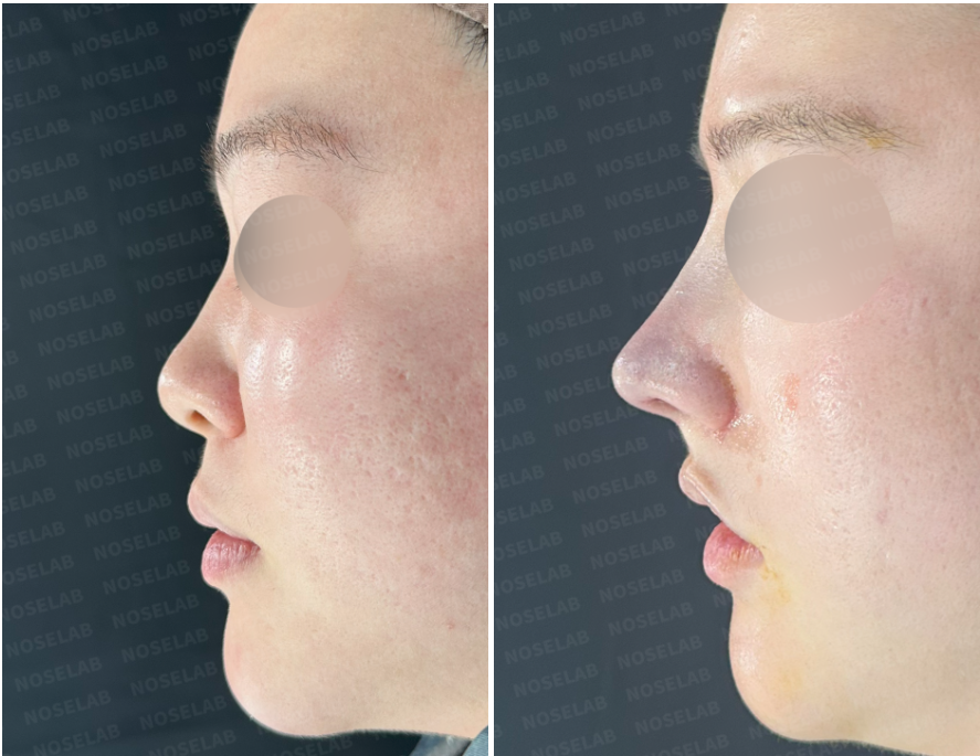 Side profile comparison before and immediately after bulbous nose correction surgery at Nose Lab Clinic, showing improved nasal projection and refined tip.