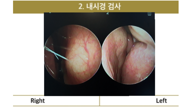 Endoscopic examination showing septal deviation to the right and enlarged left inferior turbinate, indicating nasal congestion and allergic rhinitis.