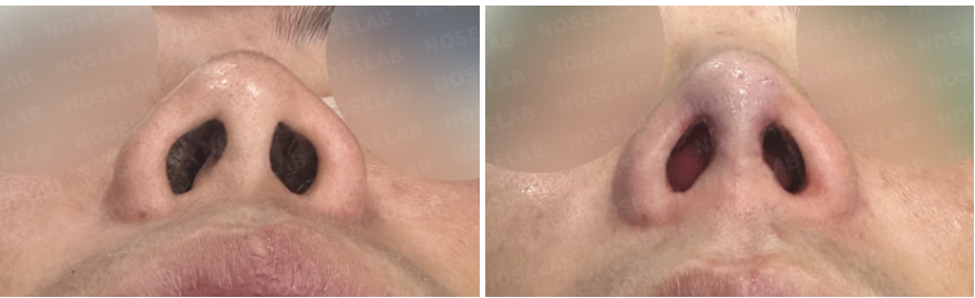 Before and immediately after nostril view comparison following closed rhinoplasty Korea, showing reduced nostril show, improved columella position, corrected nostril asymmetry, and stabilized nasal base after contracted nose revision using autologous rib cartilage.