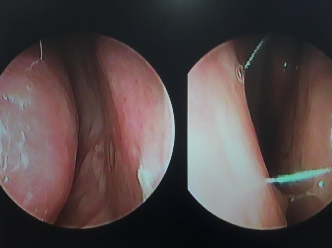 Nasal endoscopy images showing septal deviation and internal nasal structure before revision rhinoplasty.