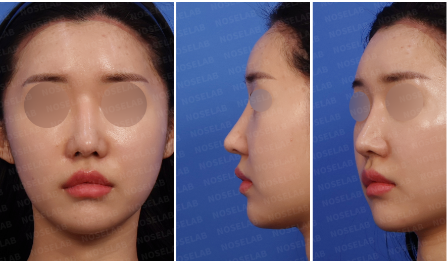 Preoperative closed rhinoplasty Korea consultation showing frontal view, left oblique view, and left side profile of a patient with septal deviation and weakened nasal support prior to rib cartilage rhinoplasty.