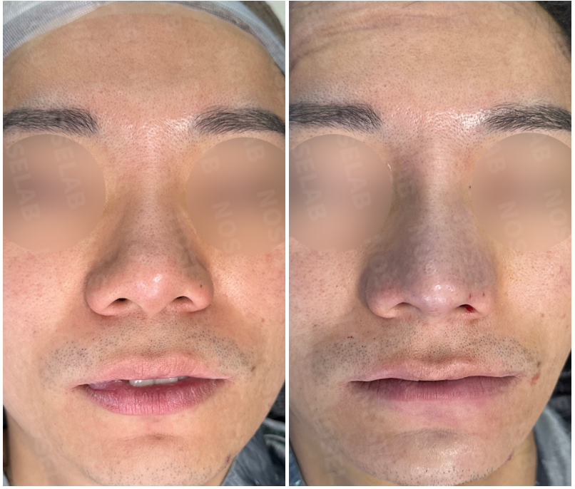 Before and after bulbous nose correction with chin surgery – frontal view showing corrected nasal deviation, symmetry, and balanced proportions