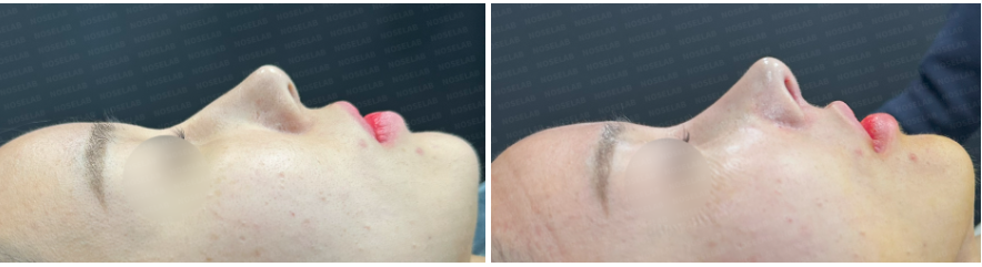 Side view before and after rhinoplasty: left shows pre-surgery, right shows immediate post-surgery results