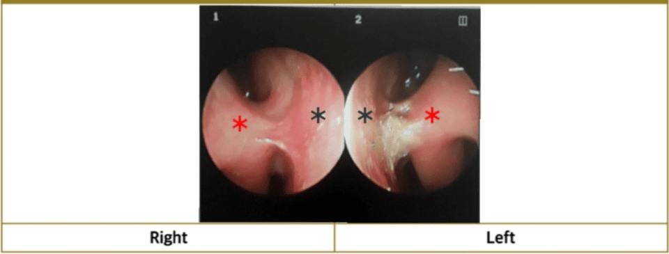Endoscopic images showing nasal mucosal adhesion (red: turbinates, black: septum) identified between the turbinates and septum on both sides before nasal mucosal adhesion correction surgery.