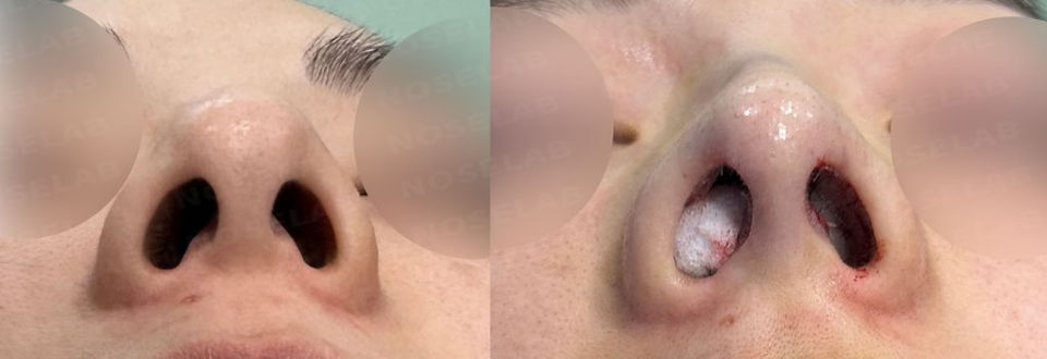 Basal view. This is a picture right after the surgery. Before the surgery (left) Right after the surgery (right)
