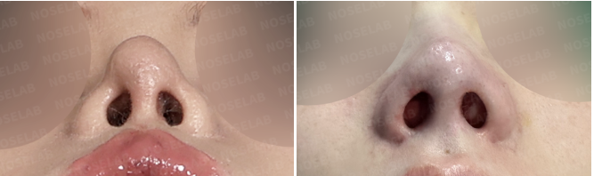 Nostril before and immediately after views showing pinched nostril correction and improved nostril symmetry.