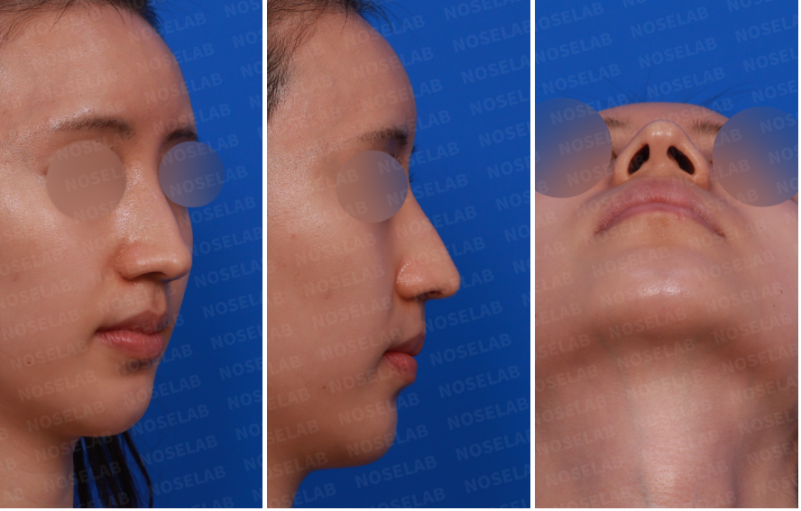 Right oblique, side, and nostril view before hump nose correction – showing nasal hump, drooping tip, and columella deviation.