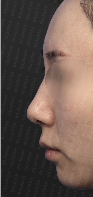 Side profile before bulbous nose surgery – prominent nasal hump, blunt tip, and high starting point.