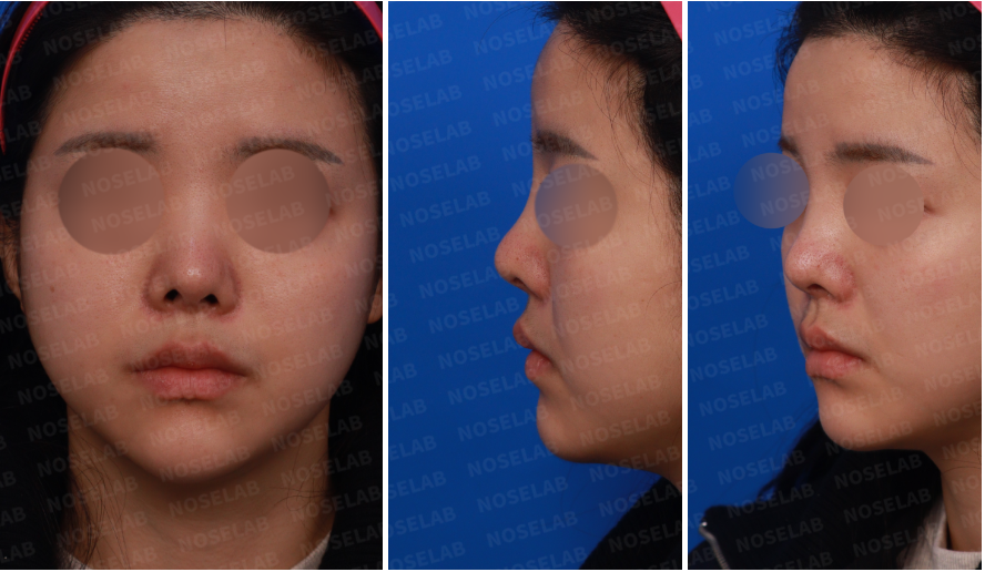 Upturned Nose Correction – Preoperative Frontal, Left Side, and Oblique Views Showing Wide Nasal Bridge and Over-Rotated Tip