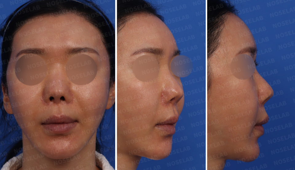 Preoperative design consultation, frontal view, 45-degree view and side profile view.
