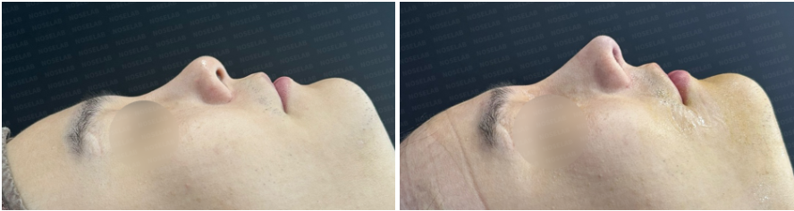 Side profile before and after male rhinoplasty Korea: straightened nasal bridge and corrected upturned tip
