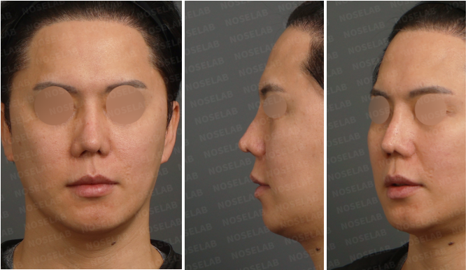 Preoperative frontal, left side, and left oblique views before rib cartilage revision rhinoplasty Korea for contracted nose reconstruction.
