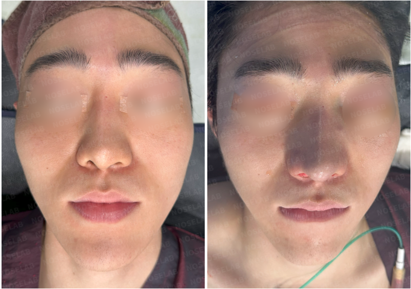 Before and after scar tissue nasal reconstruction with rib cartilage – frontal view comparison of male patient (