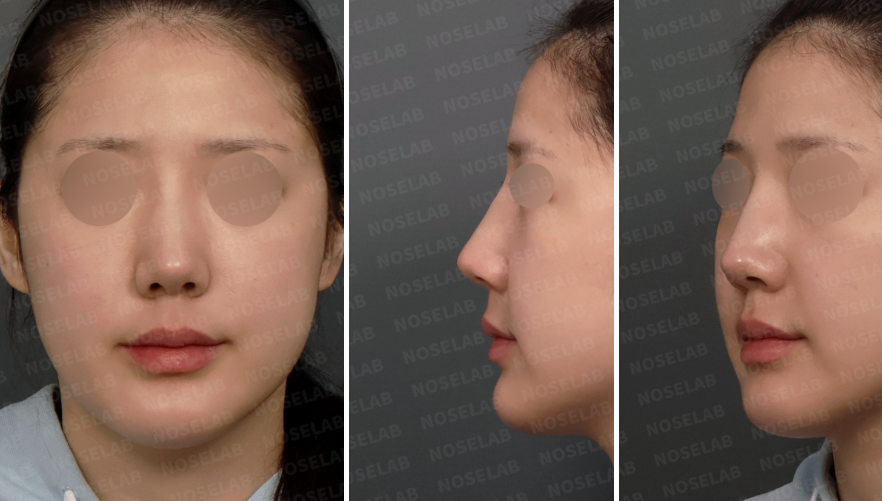Preoperative consultation photos showing frontal view, left oblique view, and left side profile of a patient with crooked nasal bones and a dorsal hump before revision closed rhinoplasty.