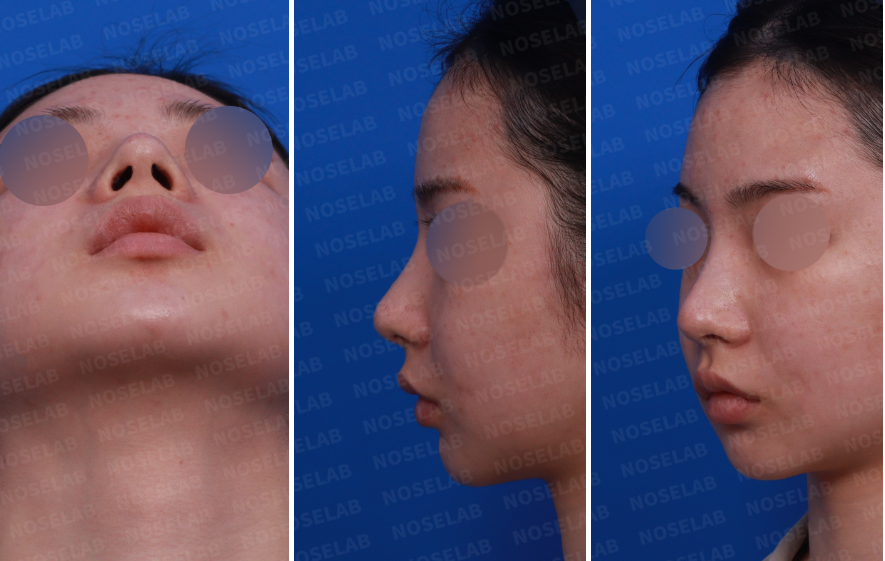 Pre-surgery design consultation photos showing a female patient’s nose from the nostril view, left side view, and oblique side view before bulbous nose correction after filler and thread lift.