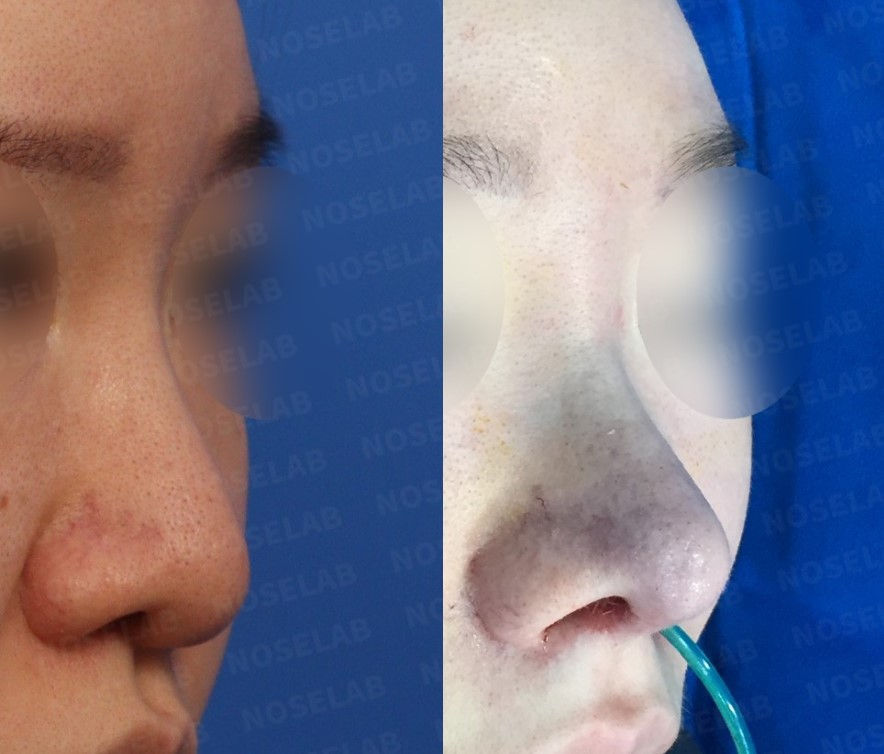 45-degree before and after Closed Rhinoplasty Seoul – natural improvement of droopy tip, bulbous nose, and nasal deviation using autologous rib cartilage at NoseLab Plastic Surgery.