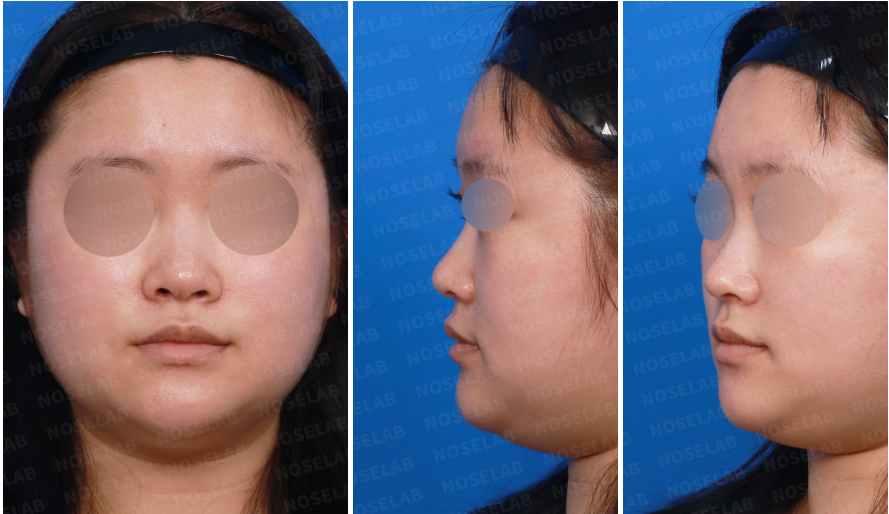 Closed rhinoplasty Korea – Preoperative design consultation photos showing frontal, oblique, and side views before septal and ear cartilage graft surgery.