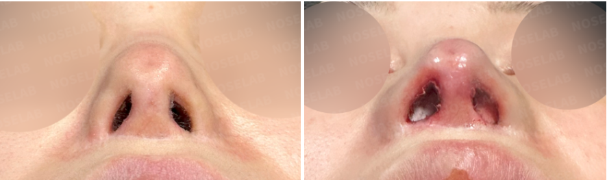 ostril view before and after comparison of rhinoplasty. Pre-surgery view on the left, post-surgery view on the right, showing corrected nostril asymmetry and refined columella