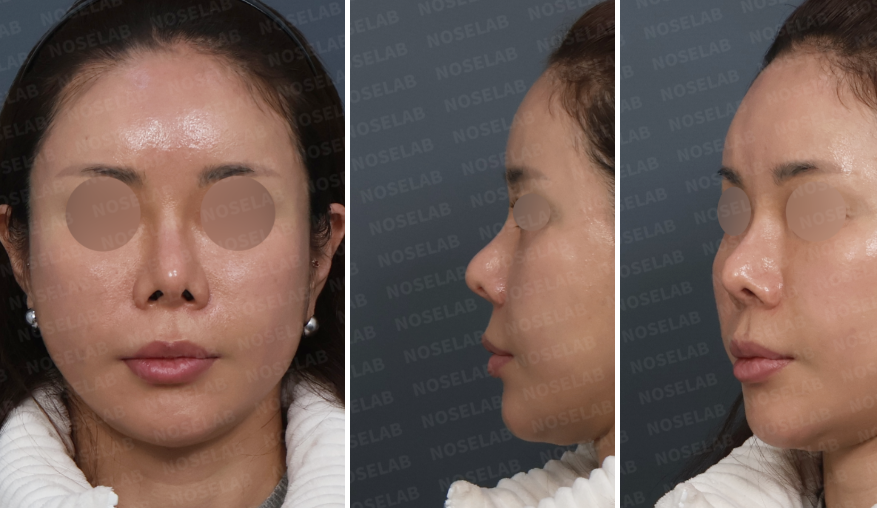 Preoperative design consultation photos showing upturned nasal tip, pinched alar deformity, and nasal asymmetry from frontal, left oblique, and left lateral views.