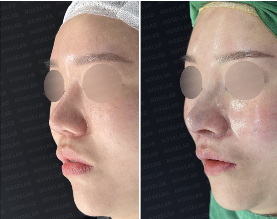 Before and immediately after surgery oblique view showing improved columellar projection and correction of the right alar deformity following revision closed rhinoplasty with autologous rib cartilage reconstruction.