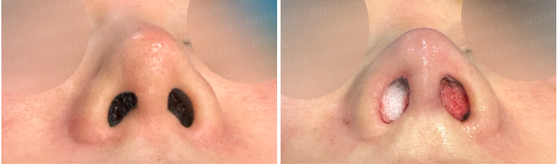 Nostril base view before revision rhinoplasty (left) and immediately after surgery (right) – nostril exposure corrected and columella projection improved.