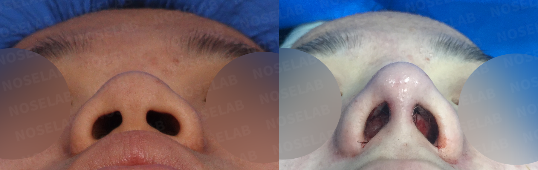 Nostril view comparison demonstrating corrected asymmetry and improved columellar position