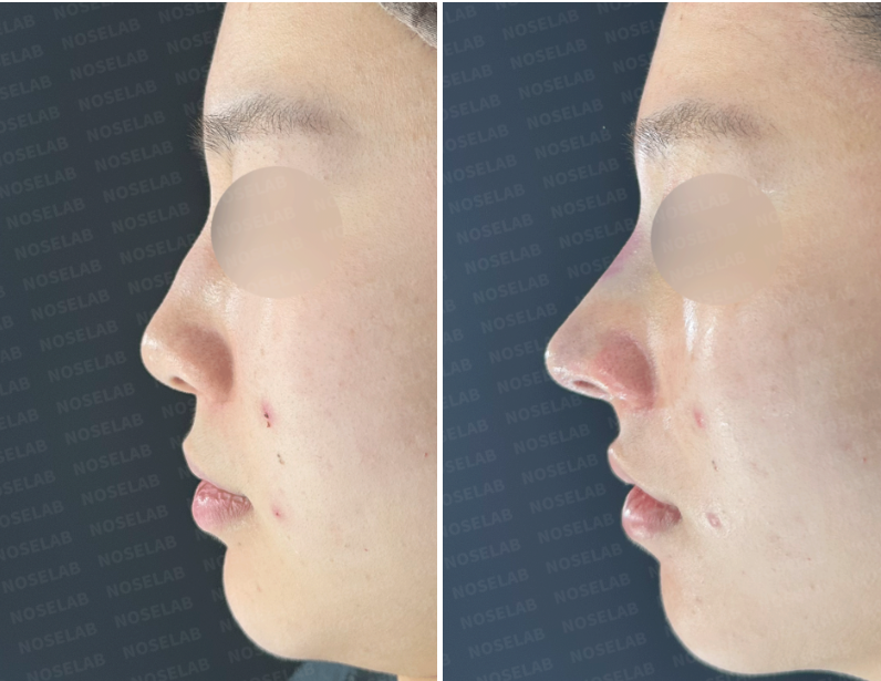 Lateral view comparison before and after rhinoplasty – improved nasal tip projection, straightened dorsal line, and corrected nasal droop.