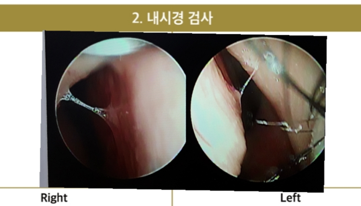 Nasal endoscopy photo before Closed Rhinoplasty Korea, showing septal cartilage leaning to the left side causing nasal obstruction.